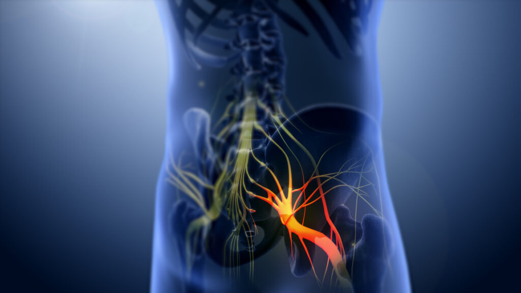 sciatic pain